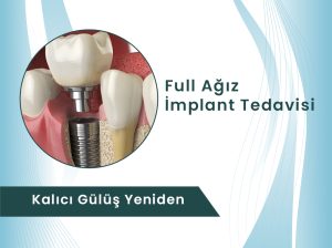 full ağız implant tedavisi