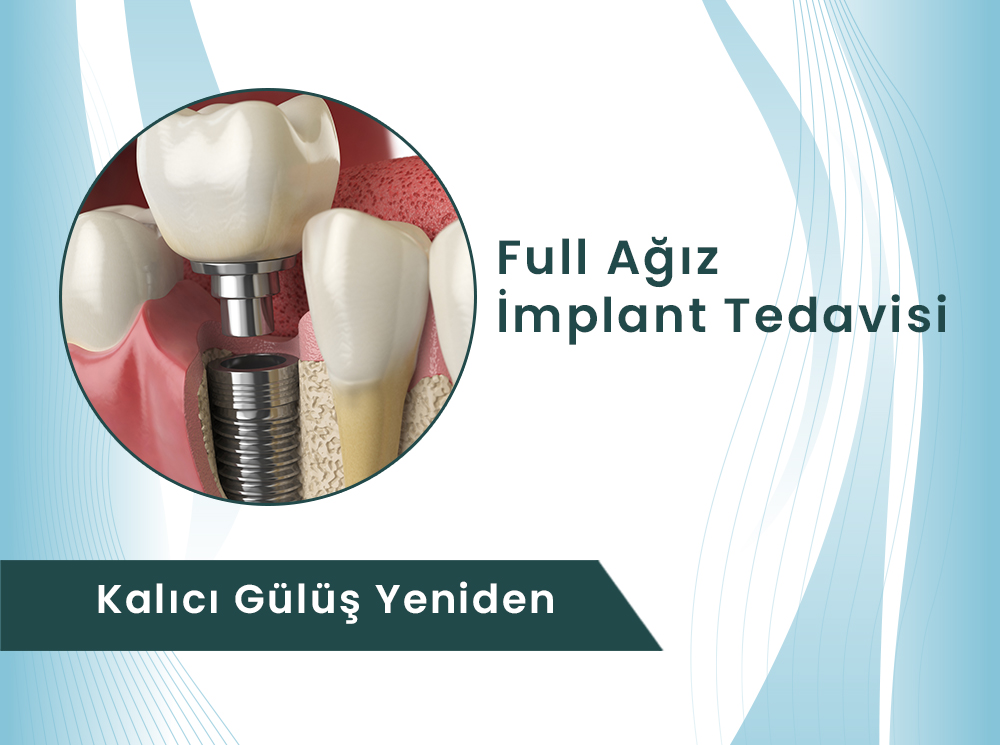 Full Ağız İmplant Tedavisi: Kalıcı ve Doğal Gülüş | Dental Rezidans