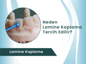 Lamine Kaplama ile Doğal ve Işıltılı Gülüşler