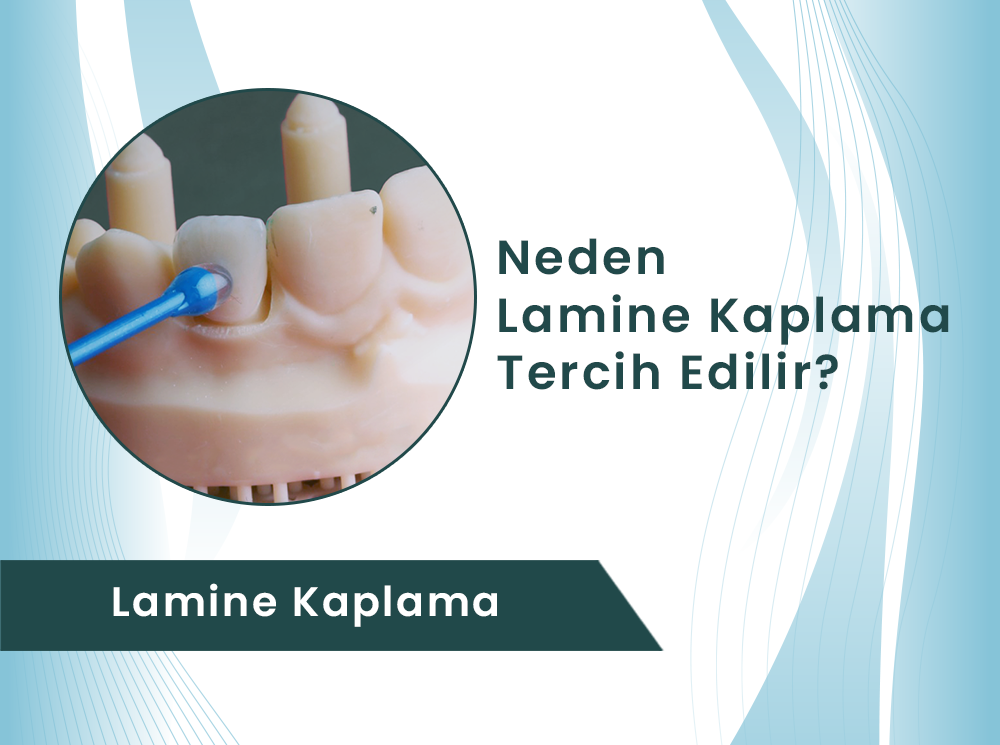 Lamine Kaplama ile Doğal ve Işıltılı Gülüşler