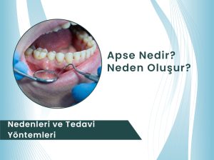 Apse Neden Oluşur Nasıl Tedavi Edilir Dental Rezidans