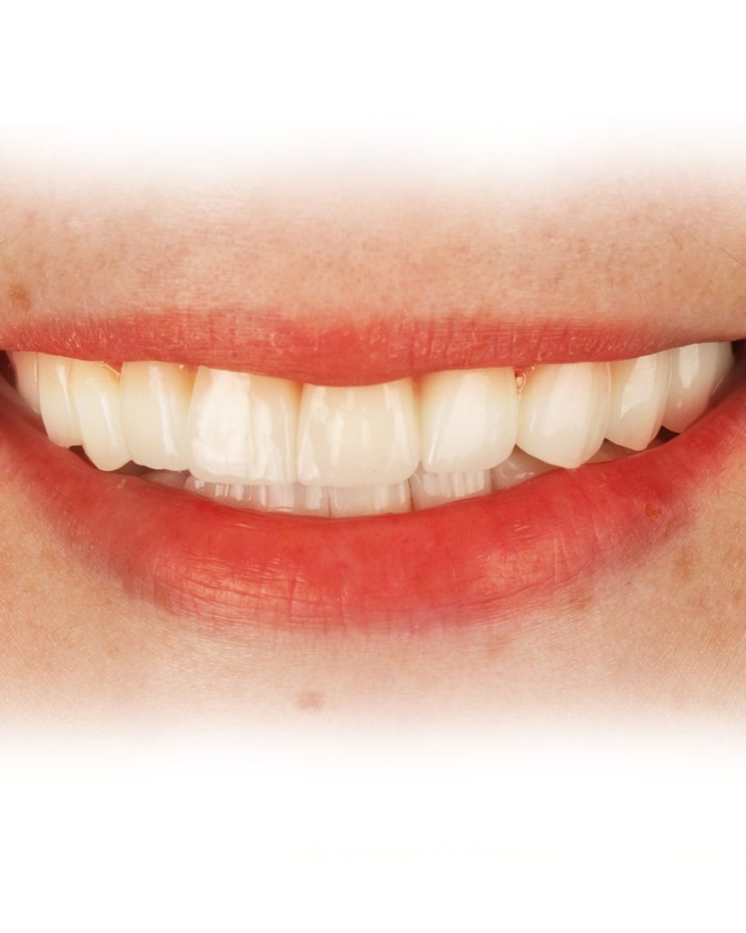 Zirkonyum Gülüş Tasarımı