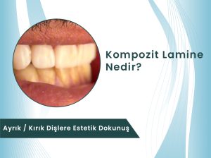 Denizli Gülüş Tasarımı - Kompozit Lamine Dental Rezidans