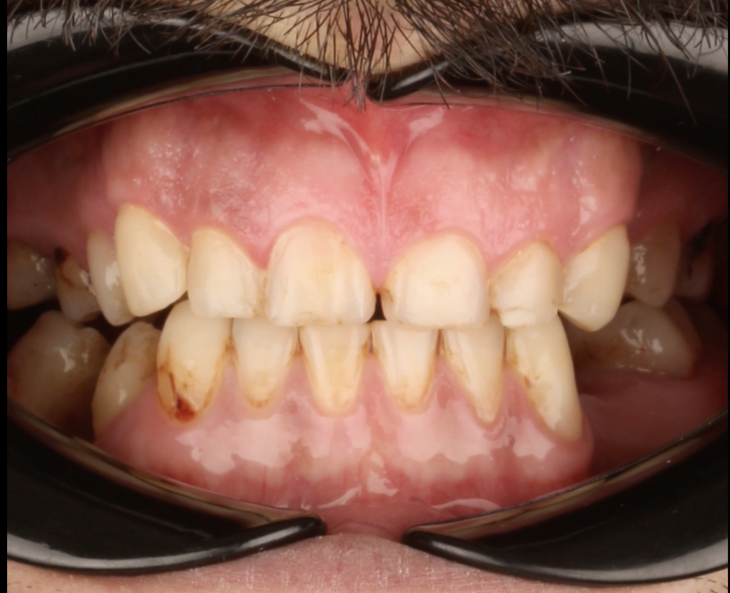 kompozit lamine tedavisi Diş aralarındaki boşlukların kapatılmasında en etkili ve koruyucu yöntemdir.