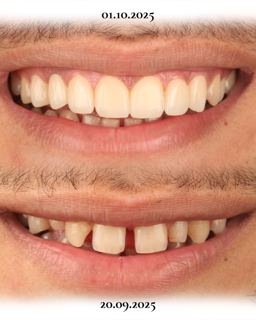 Dental Rezidans Denizli veneer kron tedavisi