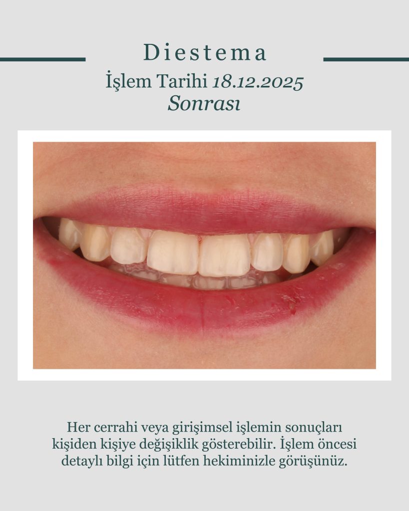 Ayrık diş (diastema) ve şekil bozukluğu şikayetiyle Denizli Dental Rezidans'a başvuran hastamıza uygulanan porselen lamine (veneer) tedavisinin kalıcı ve estetik gülüş tasarımı sonucu.