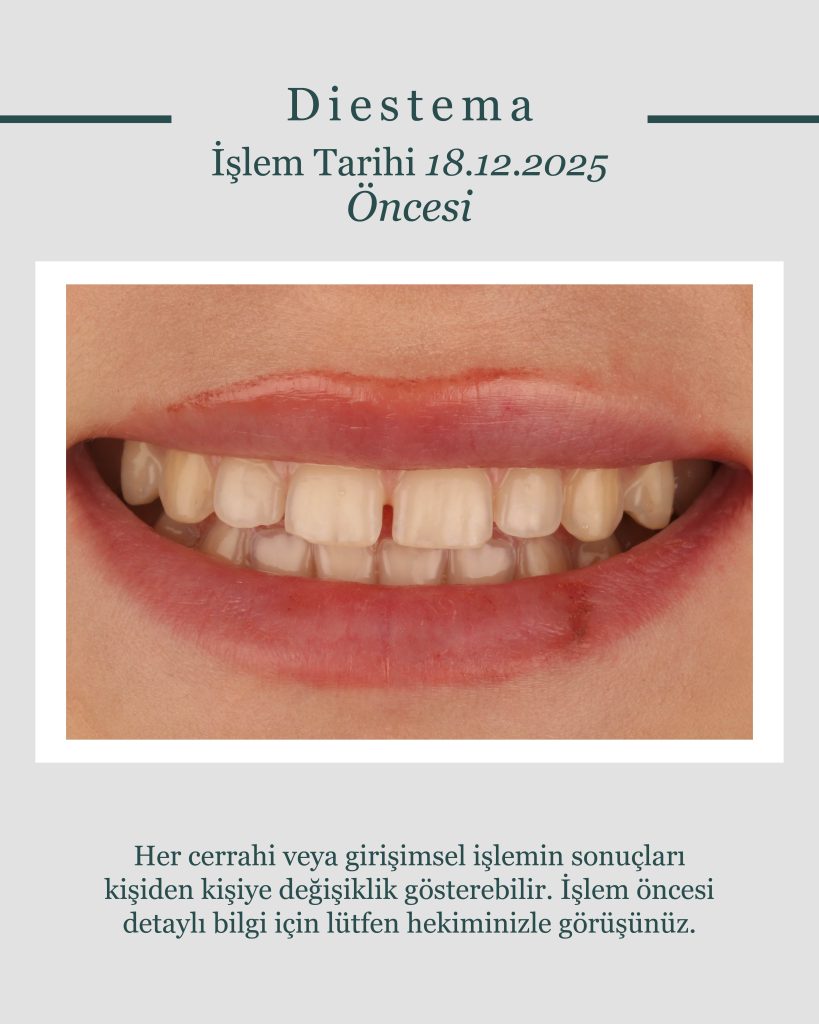 Kompozit Bonding ile Diastema Kapatma | Öncesi