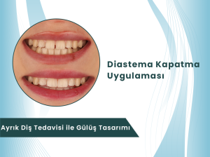 Denizli Dental Rezidans diastema ayrık diş kapatma tedavisi gülüş tasarımı