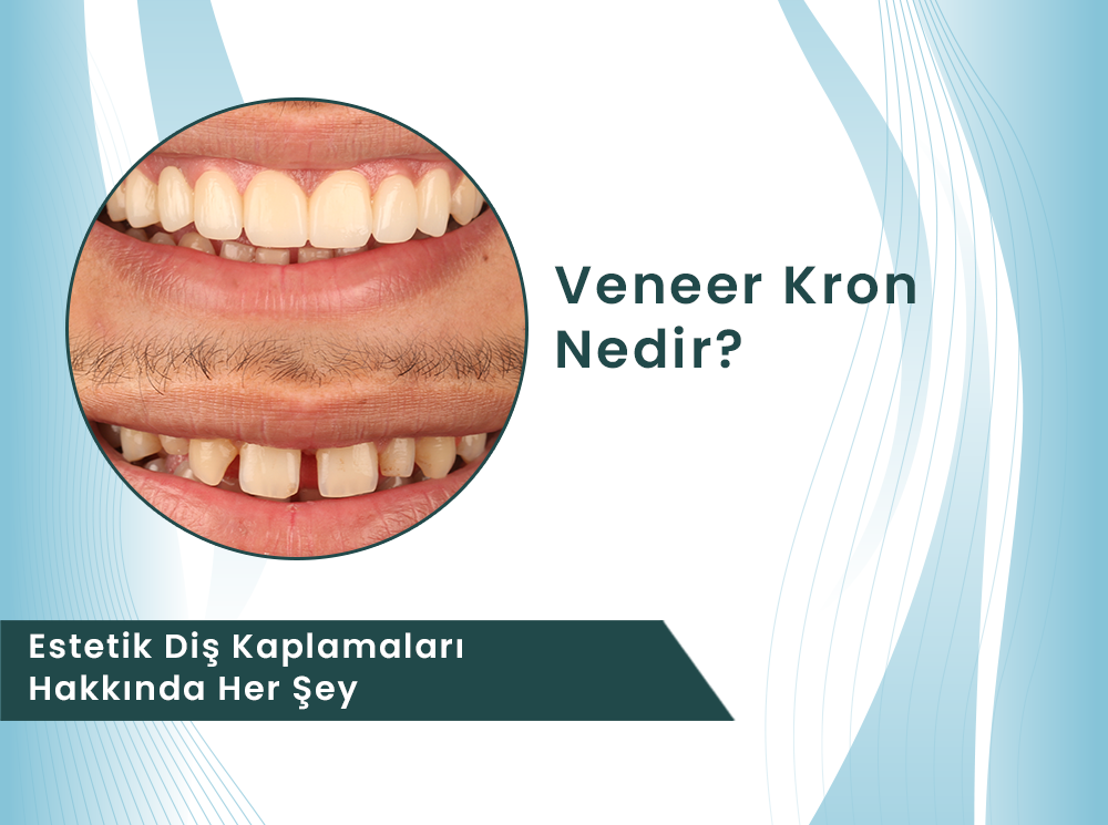 Veneer Kron Nedir? Estetik Diş Kaplamaları Hakkında Her Şey | Dental Rezidans