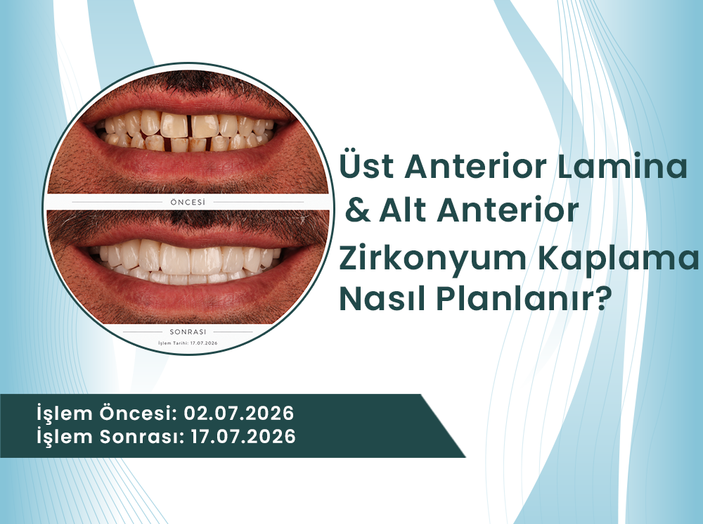 Üst Anterior Lamine / Alt Anterior Zirkonyum Kaplama Nedir?